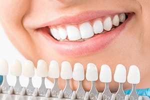 Teeth compared to whitening color chart